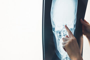 Hand pointing at x-ray photo of human skull close-up studio shot. Doctor sharing diagnosis....