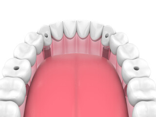 Mandibular prosthesis all on 4 system supported by implants