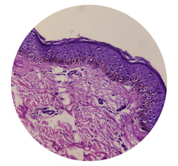 Abduminal wall skin tissue histology. Ashy dermatosis, show basal vacuolization along...