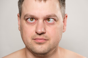 Obraz premium A man with strabismus squints his eyes on a white background.