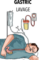 Gastric lavage with a gastric tube 