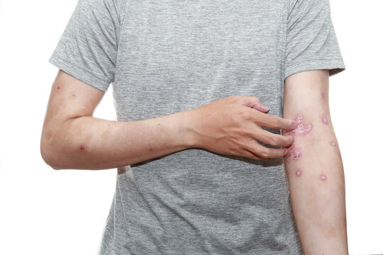 Psoriasis caused by a weakened immune system.