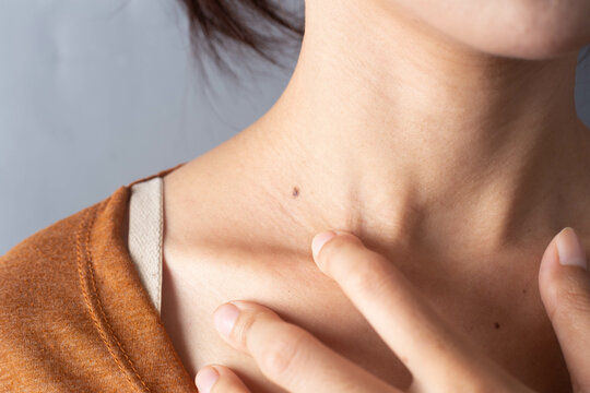 girl with a mole on her neck
