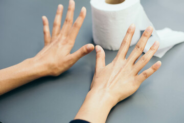 Woman spreading her sweaty hands hand of a person with symptoms Hyperhidrosis.