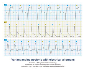 During acute transmural myocardial ischemia, the repolarization waves of ECG show beat to beat alternating changes, which is an ECG sign of impending malignant ventricular arrhythmia.