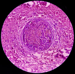 Dermoid cyst, Mature cystic teratoma, show skin, adnexal structure, fatty tissue, salivary acini...