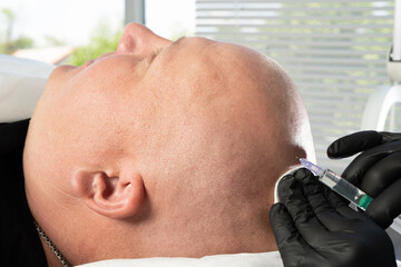 Close up of balding man getting hair mesotherapy or scalp prp. Platelet-rich plasma procedure....