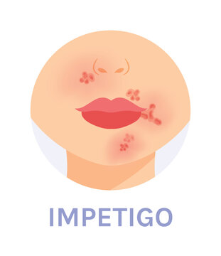 Impetigo. Skin Infection. Red Spots near the Mouth and Nose. Part of a Woman Face. Female Lips Nose and Neck. Color Cartoon style. White background. Vector image for Medical and Dermatology Design.