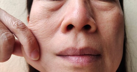 Fototapeta premium portrait showing the fingers squeezing the Flabby wrinkled beside the cheek, dullness and dark spots beside the mouth, problem blemishes and freckles on the face of the woman, concept health care.