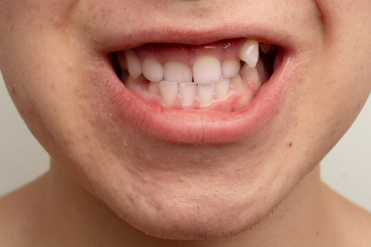 crowded teeth of adolescents with bad bites