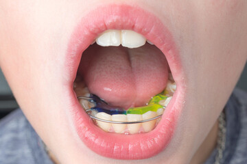 Obraz premium The boy wears a dental plate on his lower jaw.