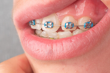 Braces with blue and yellow rubber bands close-up.