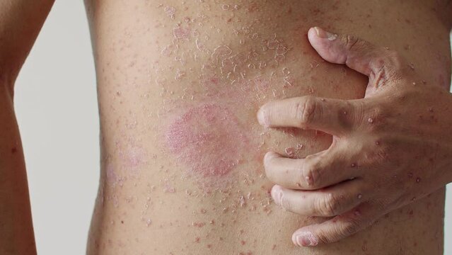 Psoriasis is the abdomen on white background. 4K Slow Motion VDO