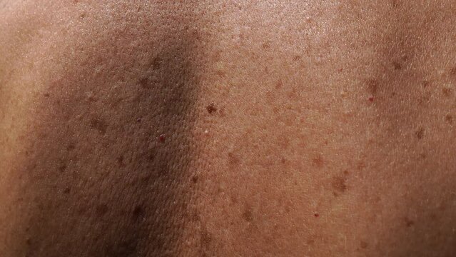 Patient's back skin covered with benign or malignant moles of different sizes, pigmented birthmarks increasing after being under the sun for a long time. Specialist's examination of moles for