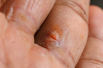Macro photo of hands with fungus crusted fingers. skincare concept.