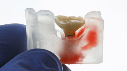 dentist holding a zircon dental crown with morphology on a model with a white background
