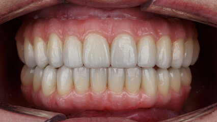 excellent dental prostheses with a beautiful artificial gum in the patient's mouth - obrazy, fototapety, plakaty