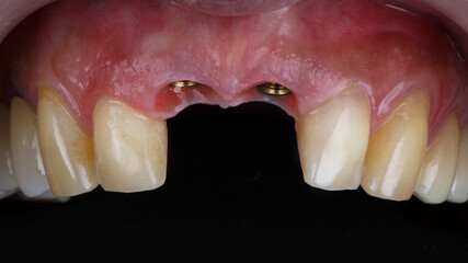 gum cavity with dental implants before installing two ceramic crowns on a black background