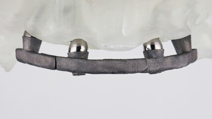 Dental bar for the prosthesis of the upper jaw on a model on a white background © Dental Pro Content