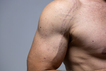 close up striae dispense. stretch marks on the arm. male torso - obrazy, fototapety, plakaty