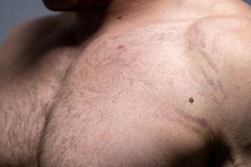 Fototapeta premium stretch marks on the arm. striae distensae 