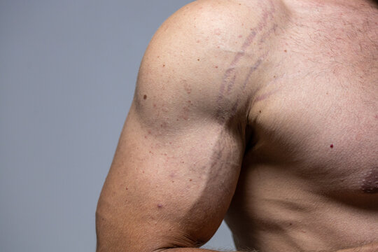 close up striae dispense. stretch marks on the arm. male torso