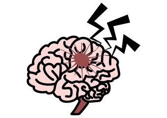 脳梗塞をおこした脳