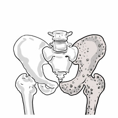  cartoon of perfectly healthy bones and compared to less dense bones osteoporosis