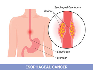 Medical illustration of the symptoms of esophageal carcinoma