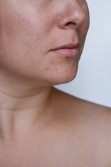 close up natural woman bad acne skin with scars