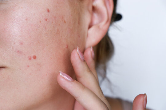 close up natural woman bad acne skin with scars