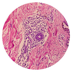Microscopic image of back skin tissue, Pemphigus vulgaris, smear show suprabasal acantholysis. Intraepidermal vesicles with round acantholytic keratinocytes. - obrazy, fototapety, plakaty