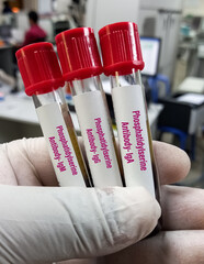 Blood samples for Phosphatidylserine antibodies(IgA,IgG,IgM) test, to diagnose antiphospholipid...