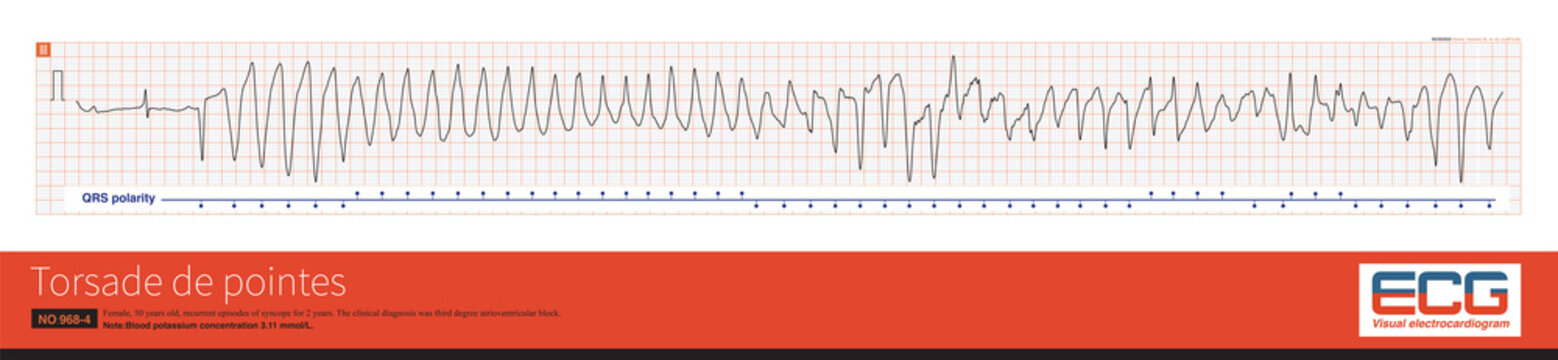 The Patient, Female, 50 Years Old, Had Recurrent Torsade De Pointe With A Blood Potassium Concentration Of 3.11. The Clinical Diagnosis Was Third Degree Atrioventricular Block.