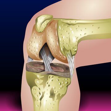 Knee joint infection, Joints and bones viral disorder, Arthritis and arthrosis, Knee trauma and injury, vector illustration on white background