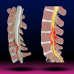 Spinal Stenosis - Fla source file available - Spinal stenosis can put pressure on the spinal cord and the nerves within the spine. It commonly occurs in the neck and lower back.