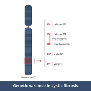 Genetic variance in cystic fibrosis. Deleted CTT nucleotide results in malfunctioning CFTR protein. Genetic pathology leads to cystic fibrosis that causes sticky mucus to build up in lungs and stomach