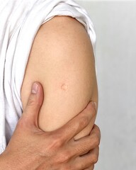 BCG or TB vaccine scar mark at the arm of Asian man.