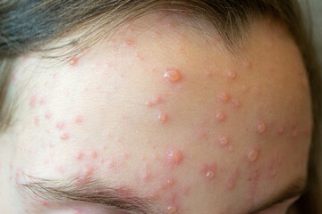 Varicella virus or Chickenpox bubble rash on child