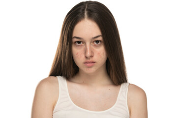 beautiful young women with problemati skin.