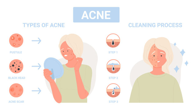 Type of acne on facial skin, steps of infection treatment for face pores infographic flat vector illustration. Cartoon girl with dermis problem of inflammation, scars. Medicine, skincare concept