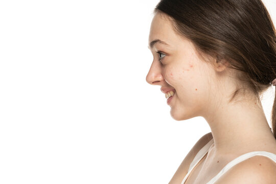 Profile view of a beautiful young smiling women with problematic skin