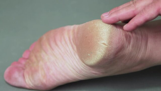A hand rubs the keratinized skin of the heel of a man's foot. Keratinization and thickening of the epidermis in the sole of the foot. Foot care concept. Isolated video, close-up. UHD 4K.