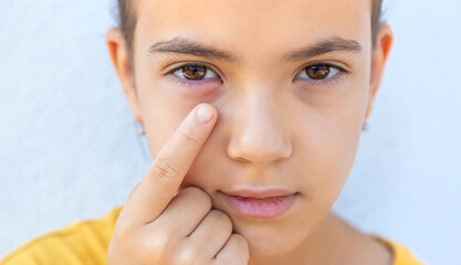 The child eye is inflamed. Selective focus.
