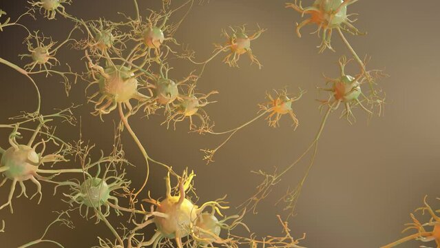 Mild Traumatic Brain Injury, damaged neurons, alzheimers disease, diffuse axonal injury, disruption in nerve communication,  3d render