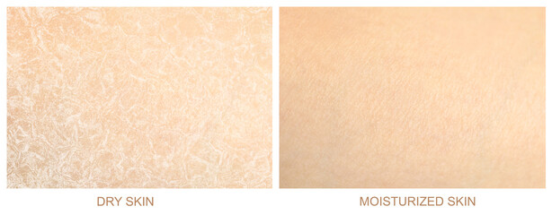 Collage with photos of dry and moisturized human skin, closeup. Banner design