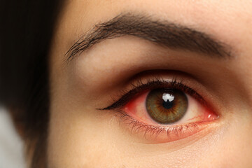 Obraz premium Closeup view of woman with inflamed eyes