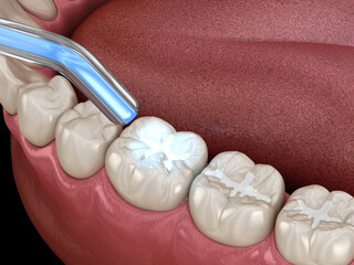 Tooth restoration with filling and polymerization lamp. Dental 3D illustration - 521975657