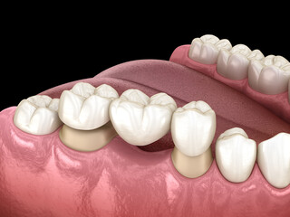Molar and premolar tooth and dental bridge placement. Medically accurate 3D illustration