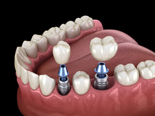 Premolar and Molar tooth crown installation over implant, screw fixation. 3D illustration of dental treatment
